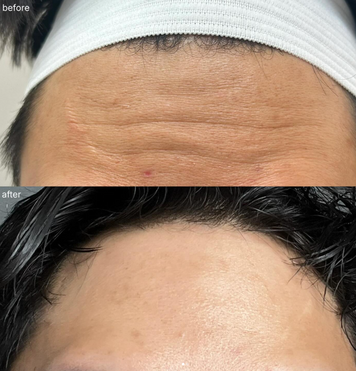Forehead line softening results referenced during Clearfield injectables consultation