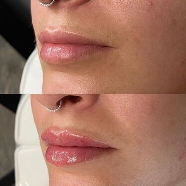Soft natural lip filler look discussed in Clearfield injectables consult