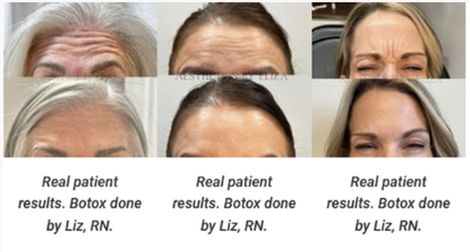 Before and after injectables results strip — Hyde Beauty & Wellness Clearfield